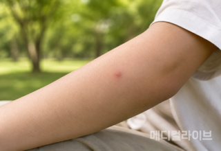 모기 물린 곳, 가렵다고 계속 긁었다간…붓기·감염 위험 커질 수 있어