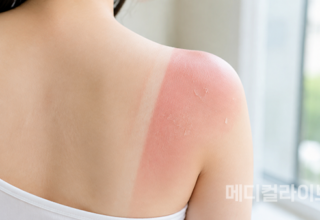 햇볕에 탄 뒤 피부가 벗겨진다면…억지로 떼어내지 마세요